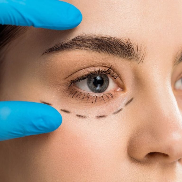EYELID SURGERY 1